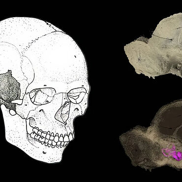 Schädelknochen - Collage