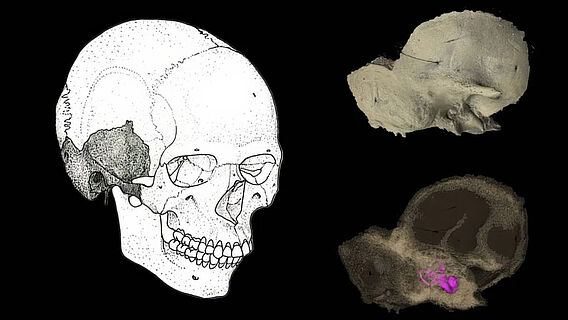 Schädelknochen - Collage