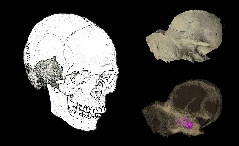 Schädelknochen - Collage