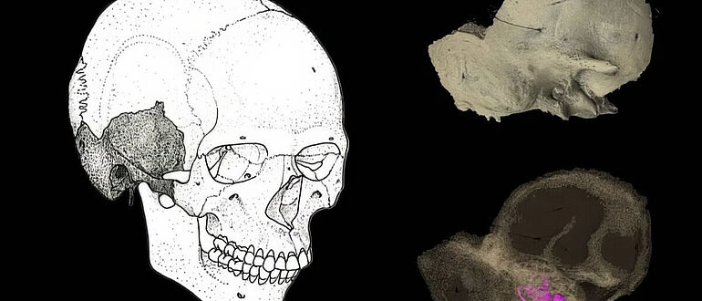 Schädelknochen - Collage