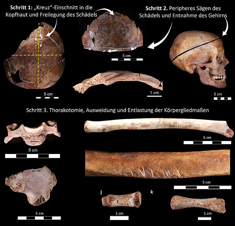 Schritte des Einbalsamierungsverfahrens und Auswahl von Knochenteilen, die Anzeichen der Operation aufweisen