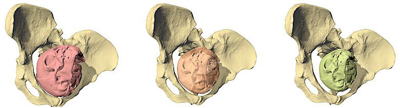 Geburtssimulation von Lucy (Australopithecus afarensis) mit drei unterschiedlich grossen Fetuskopfgrössen