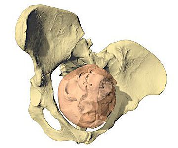 Geburtssimulation von Lucy (Australopithecus afarensis) mit drei unterschiedlich grossen Fetuskopfgrössen