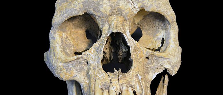 Neolithischer Schädel aus Karsdorf mit Hepatitis-B-Infizierung