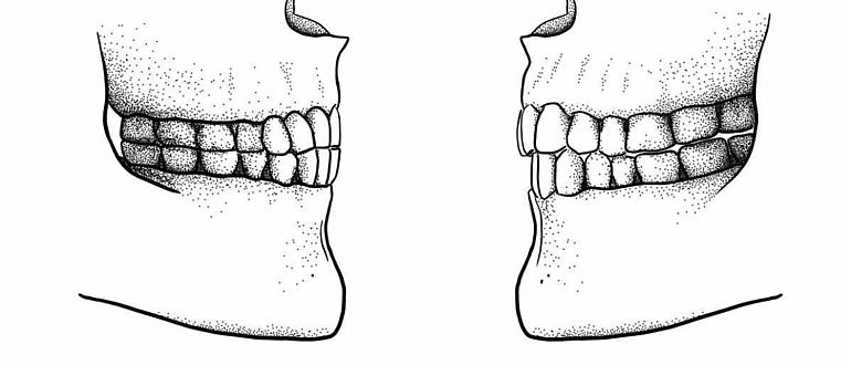 Paläolithischer Kopfbiss (links), und moderne Gebissform (rechts) im Vergleich.