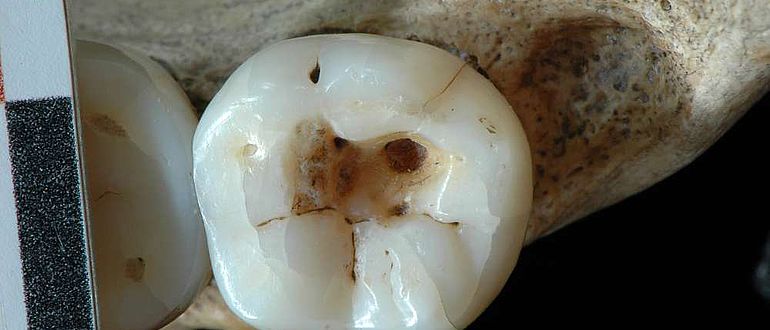 Loch im rechten unteren dritten Backenzahn