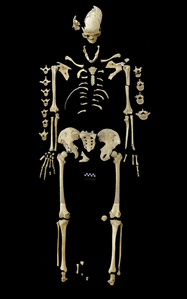 Skelett Leukämie Neolithikum