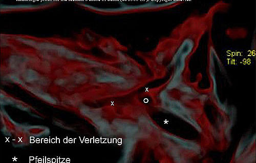 Das CT-Bild zeigt die Verletzung und die Pfeilspitze. (Foto: © Elsevier)