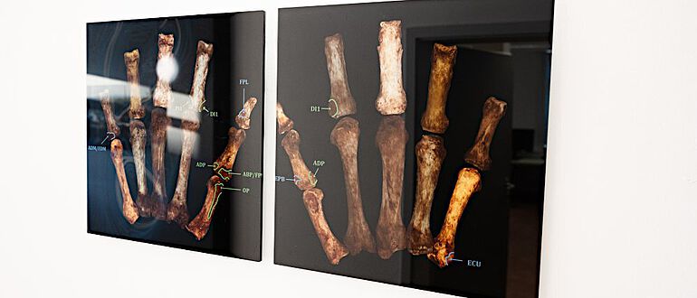 3D-Modell von Handknochen, mit Markierungen, wo die Muskeln ansetzen