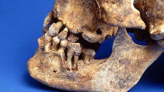 Zahnsteinbildung im Mittelalter