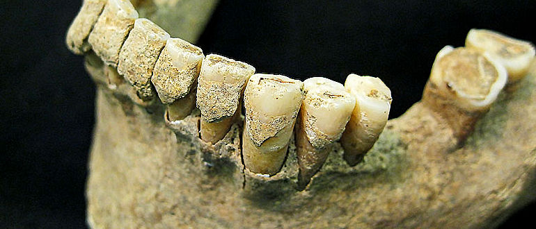 Mittelalterlicher Zahnstein