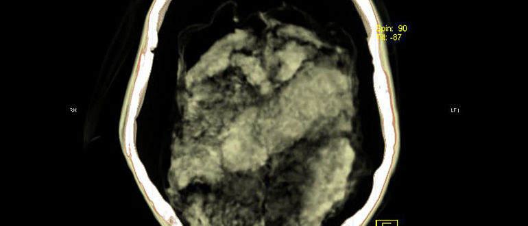 Querschnitt durch Ötzis Schädel mit Gehirn